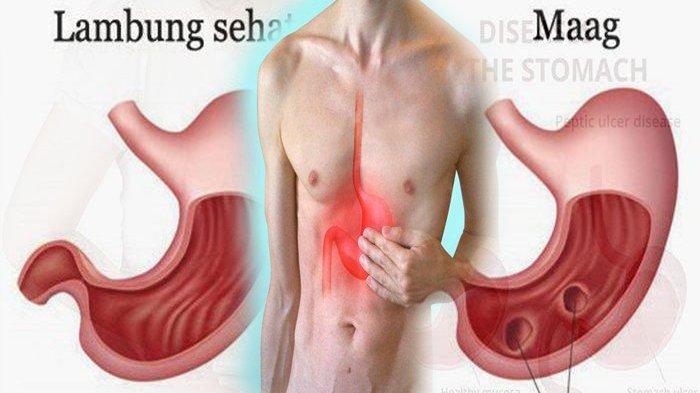 8 Cara Mengatasi Penyakit Maag Supaya Tidak Kambuh Lagi